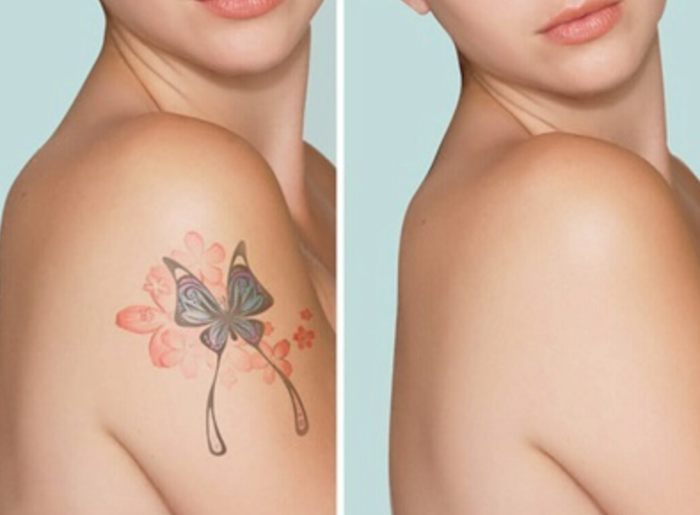 Rejuvi Non-Laser Tattoo Removal Service Dubai​​ | Select Beauty Solutions
