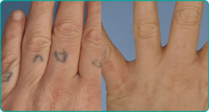 INDIAN-INK-TATTOO-REMOVAL-hands