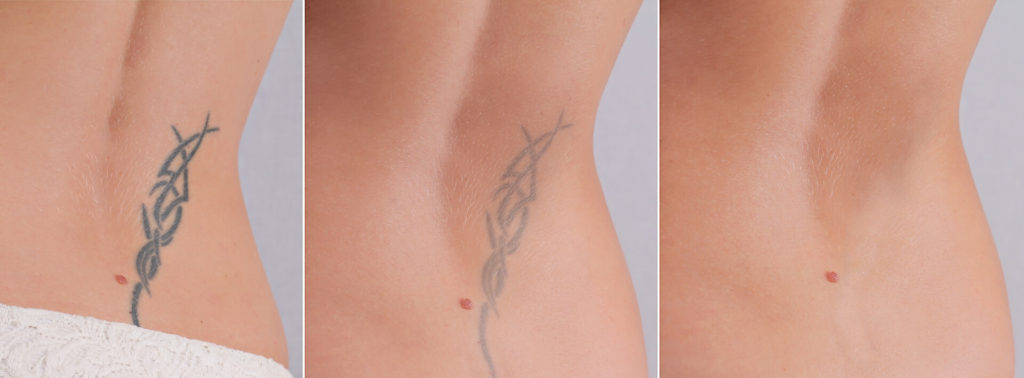 Tattoo Removal at Dr. V Medical Aesthetics: Quick and Painless