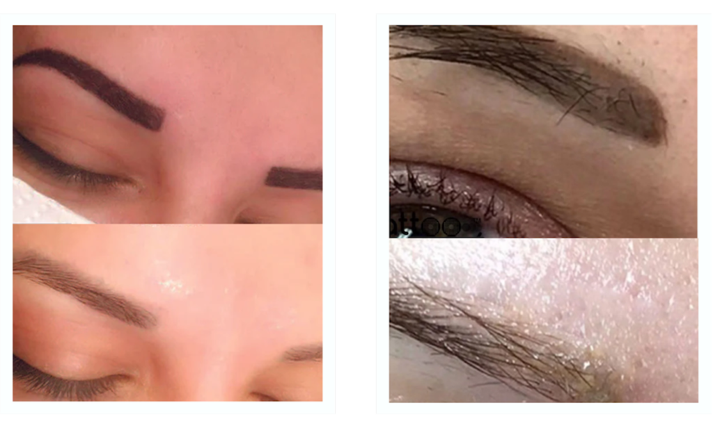 eybrows tattoo removal