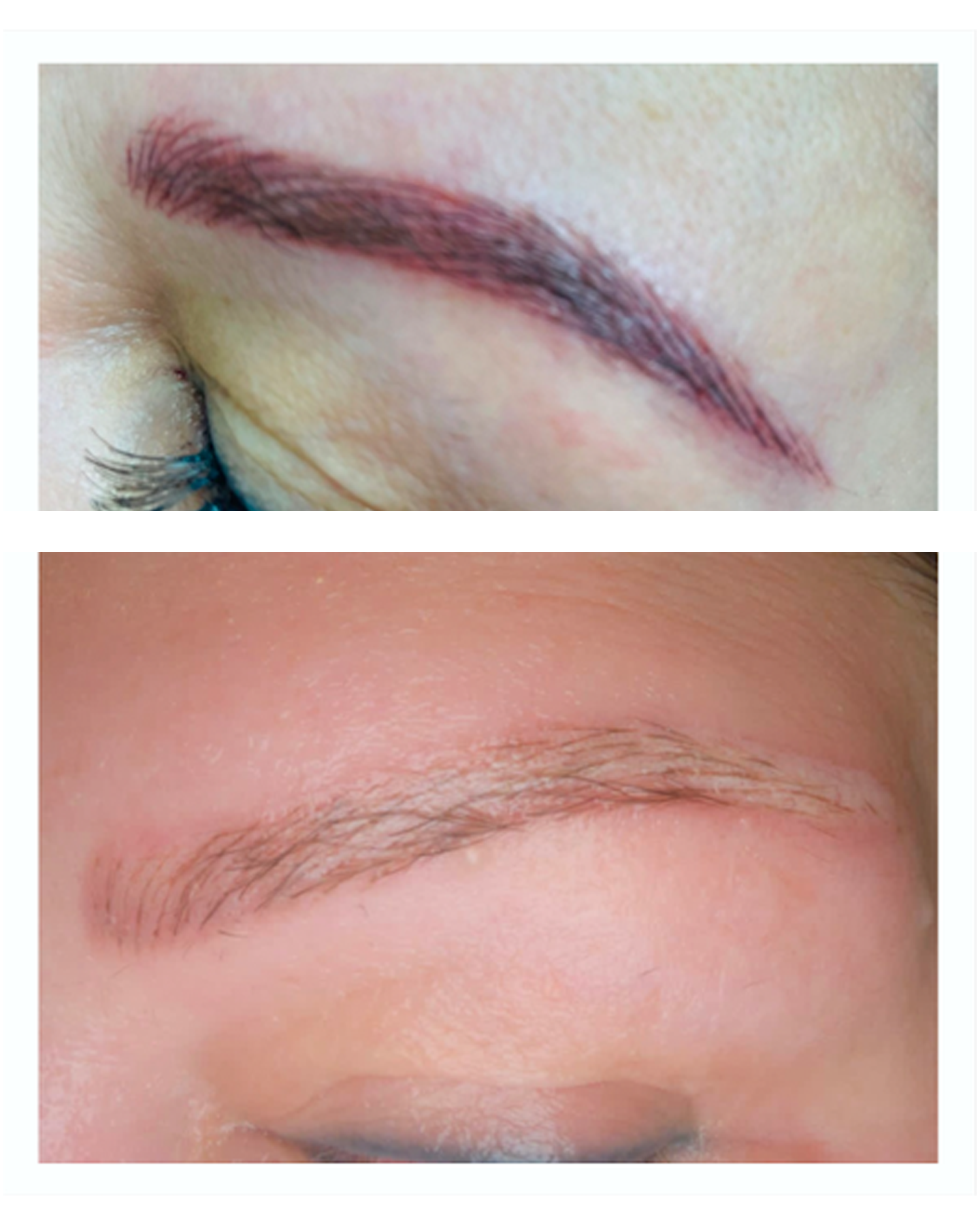 eyebrows tattoo removal