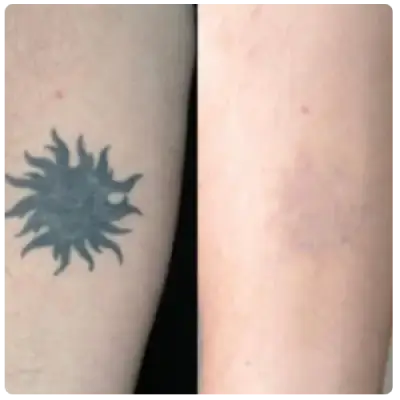 Rejuvi Tattoo-Removal-UAE