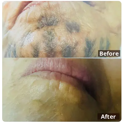 Tribal-Tattoo-Removal-uae